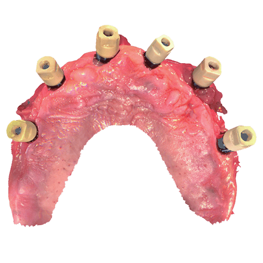 Phục hình trên implant